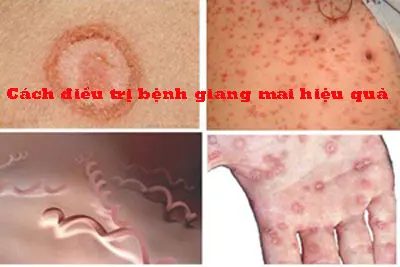 Cách phòng ngừa bệnh giang mai