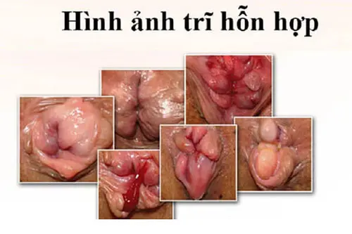 Hình ảnh bị trĩ hỗn hợp cụ thể