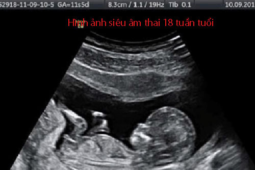 hinh-anh-sieu-am-thai-18-tuan-tuoi Hình ảnh siêu âm thai 18 tuần tuổi