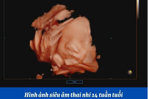 Hình ảnh siêu âm thai nhi 14 tuần