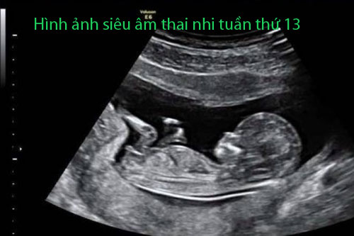 Hình ảnh siêu âm thai nhi tuần thứ 13